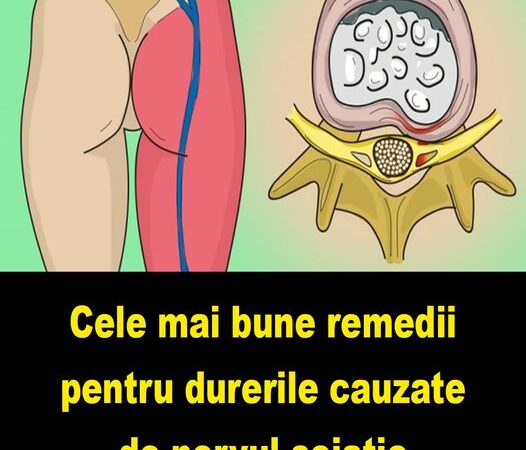 Cel mai bun remediu pentru durerile cauzate de nervul sciatic Listă făcută de un medic foarte bun